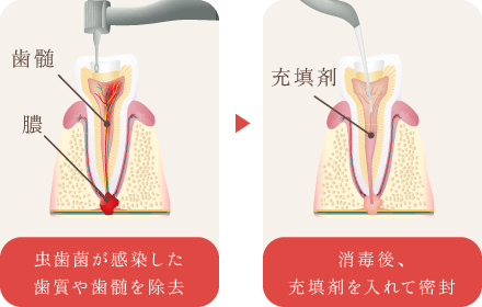 虫歯菌が感染した歯質や歯髄を除去/消毒後、充填剤を入れて密封