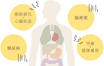 動脈硬化・心臓疾患 脳梗塞 糖尿病 早産・低体重児